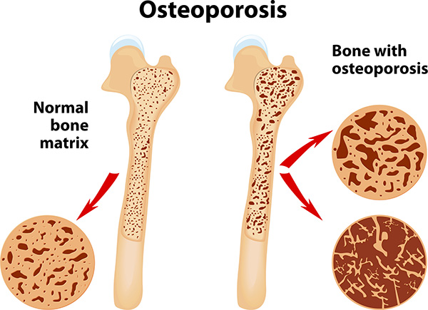 заболяване на костите - остеопороза
